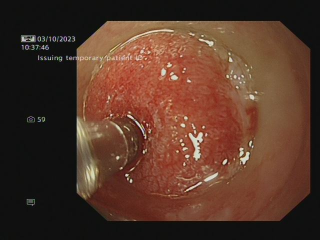 view of oesophageal tissue being screened for cancer in contact with the RaPIDE probe